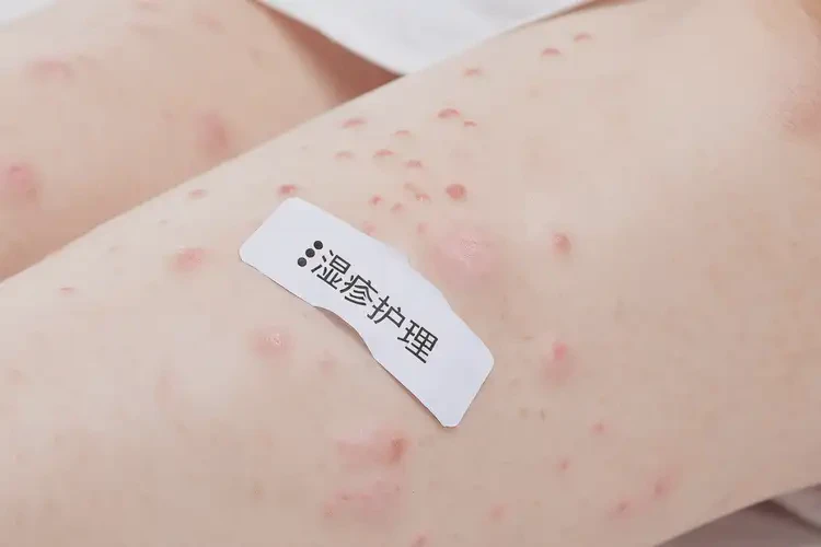 少兒小腿上起濕疹不管它會自己痊愈嗎(圖4)