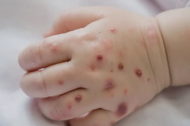 嬰幼兒手上容易起濕疹可以徹底自愈嗎(圖4)