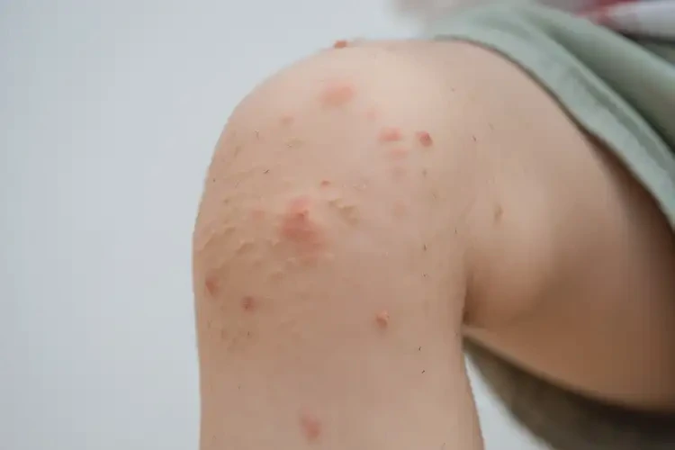 兒童大腿上經(jīng)常長濕疹能靠自己自愈嗎(圖4)