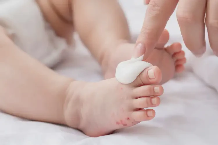 嬰兒腳上起濕疹能徹底自愈嗎(圖3)