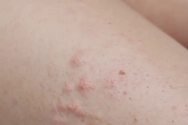 小孩大腿上容易起濕疹不管它會自己痊愈嗎(圖4)