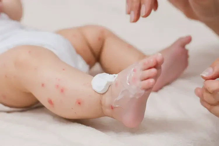 嬰兒小腿上出現(xiàn)濕疹不管它會自己自愈嗎(圖3)