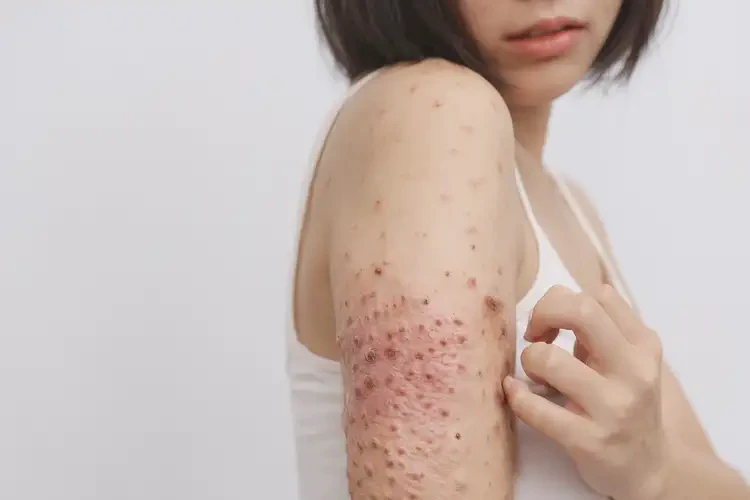 女生手臂出現濕疹能靠自己自愈嗎(圖4)