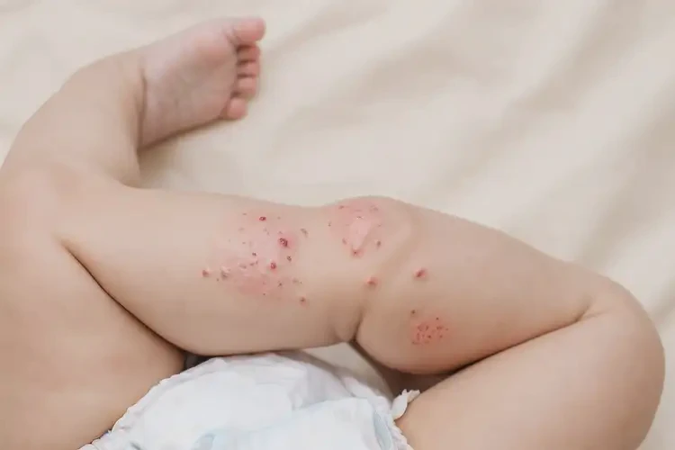 婴儿大腿上经常起湿疹可不可以彻底自愈(图3)