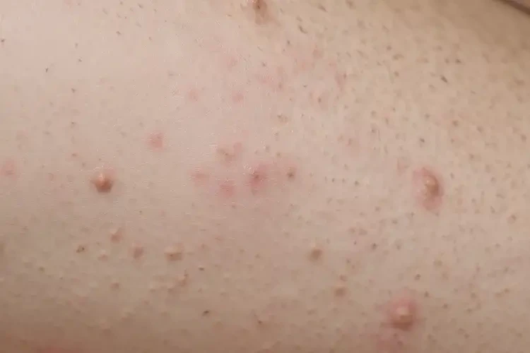 男生大腿偶尔起湿疹能彻底自愈吗(图4)