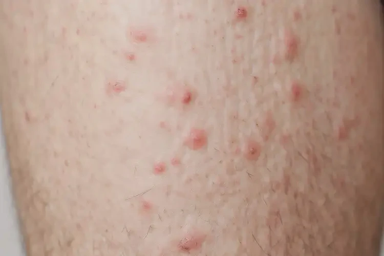 男性大腿偶尔长湿疹能靠自己自愈吗(图4)