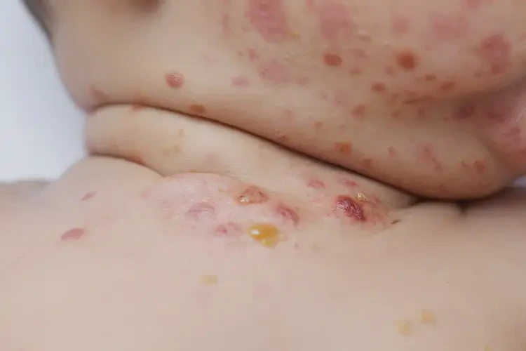 宝宝脖子起湿疹不管它会自己痊愈吗(图1)