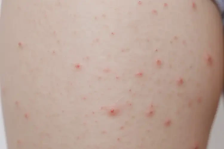 孩子大腿上出濕疹不管它會自己自愈嗎(圖4)