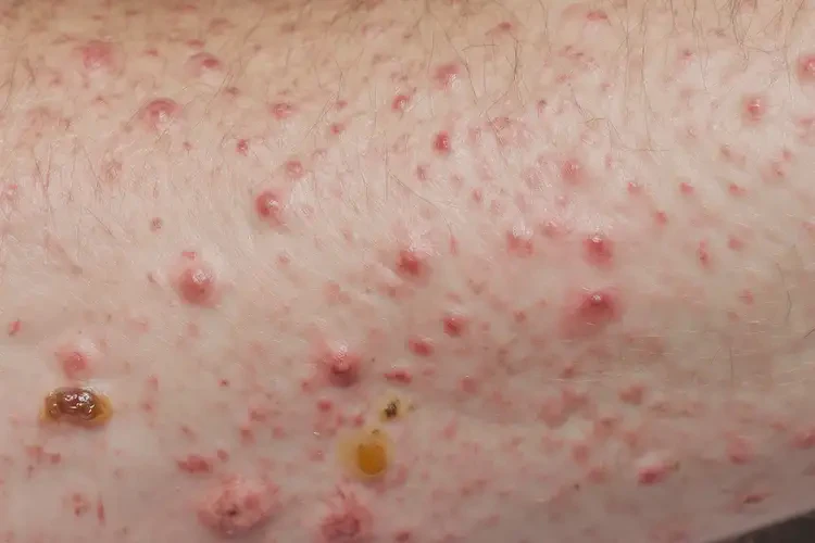 小學(xué)生大腿容易長(zhǎng)濕疹不管它會(huì)自己自愈嗎(圖2)