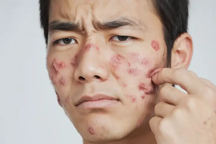 男生身上容易起濕疹能夠徹底治愈嗎(圖4)