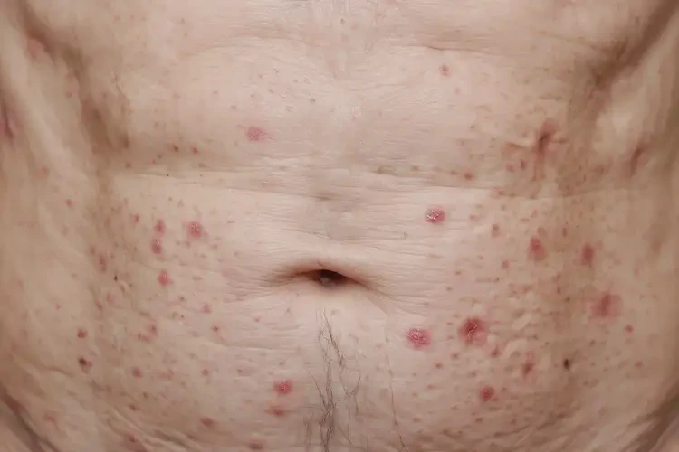 老人肚子出现湿疹可不可以彻底自愈(图4)