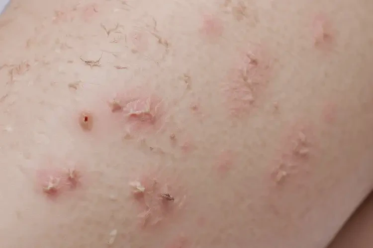 青少年大腿有濕疹能徹底自愈嗎(圖4)