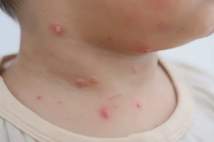 少兒脖子上出濕疹能靠自己自愈嗎(圖4)