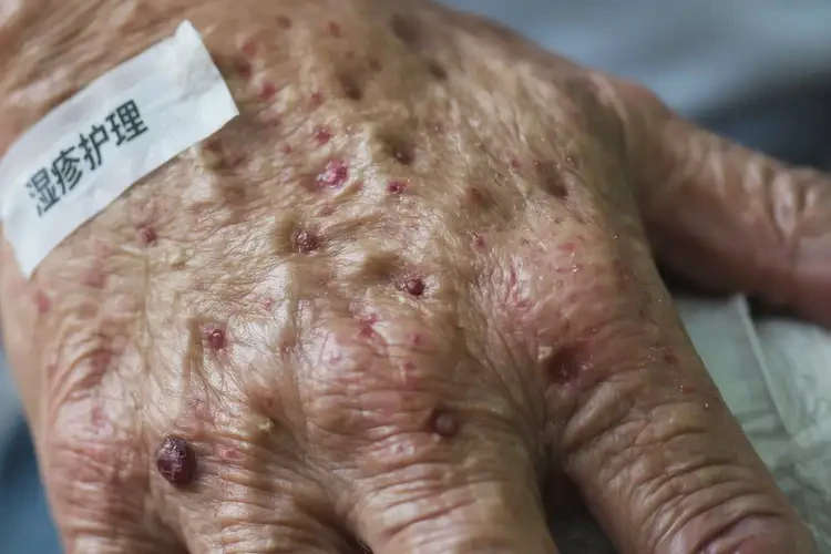 老人手上容易起濕疹能靠自己自愈嗎(圖4)