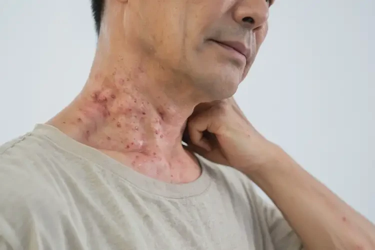 男性脖子經(jīng)常起濕疹可以徹底自愈嗎(圖2)