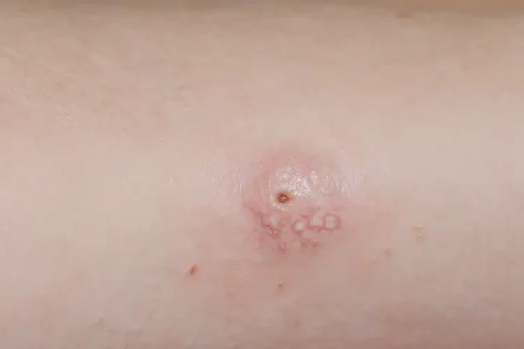 少兒屁股上經(jīng)常起濕疹不管它會(huì)自己痊愈嗎(圖4)