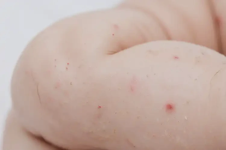 寶寶小腿出濕疹不管它會(huì)自己自愈嗎(圖4)