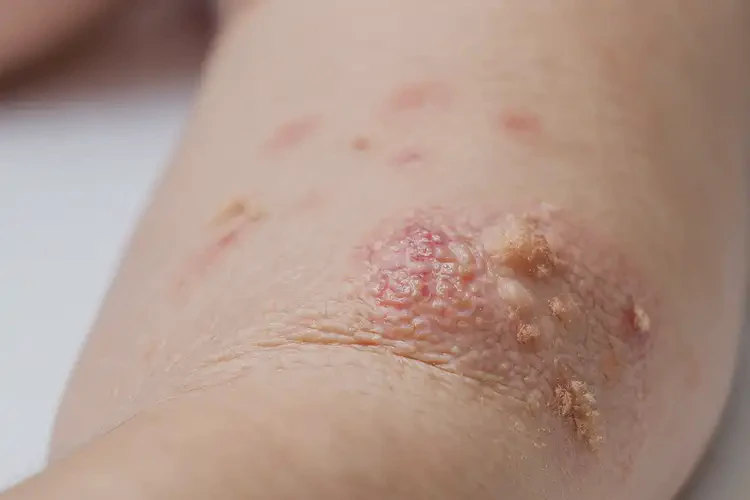 小兒手臂上起濕疹可不可以徹底自愈(圖4)