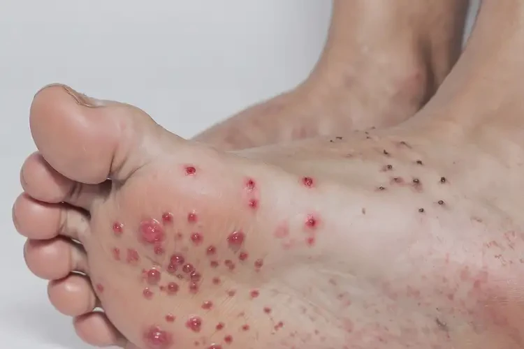 中學(xué)生腳上起濕疹不管它會(huì)自己好嗎(圖4)