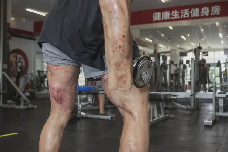 大學生大腿上容易起濕疹可不可以徹底自愈(圖1)