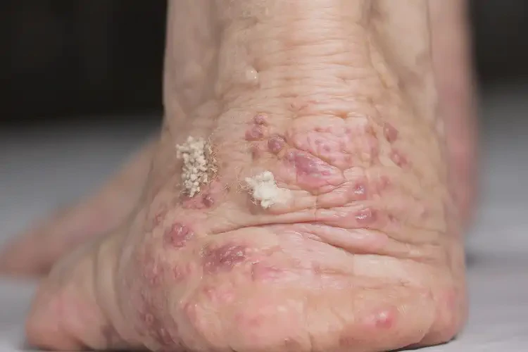 女性腳上經(jīng)常起濕疹不管它會自己自愈嗎(圖3)