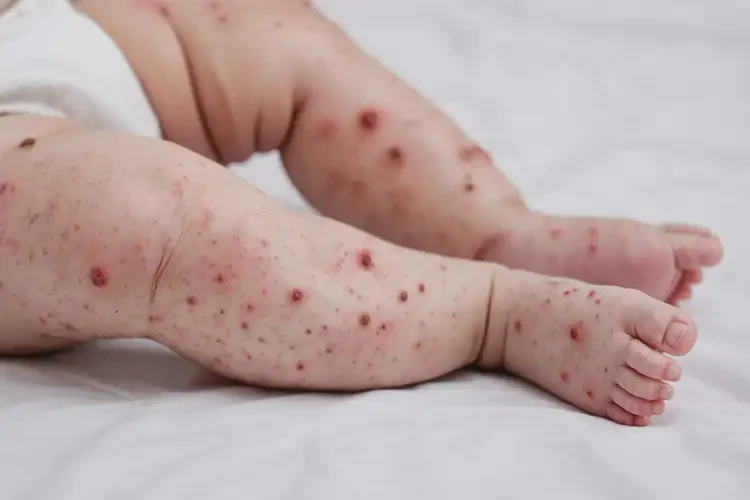 嬰幼兒大腿長濕疹不管它會自己好嗎(圖3)