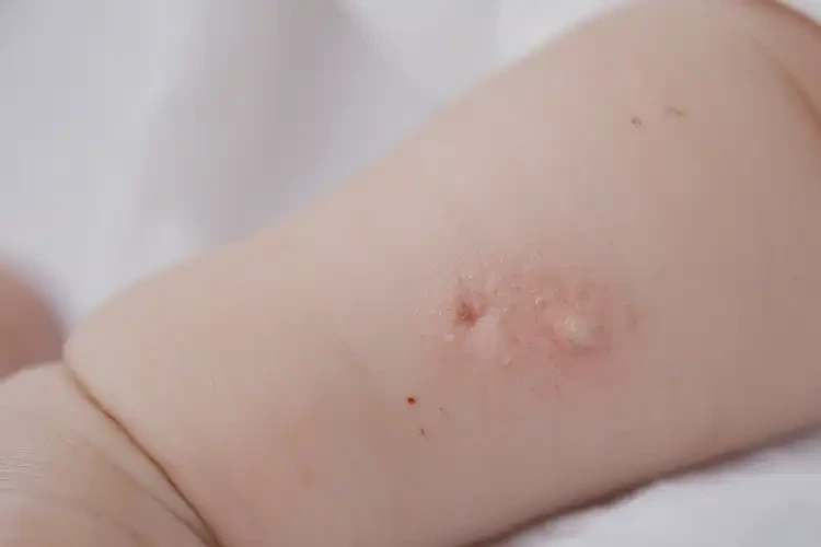 幼兒手上出現(xiàn)濕疹不管它會自己好嗎(圖4)