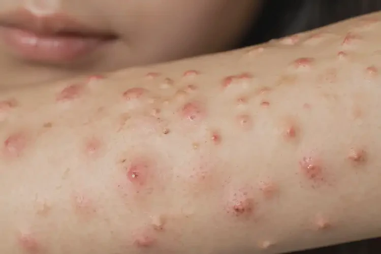 女生手臂上有濕疹能徹底自愈嗎(圖4)