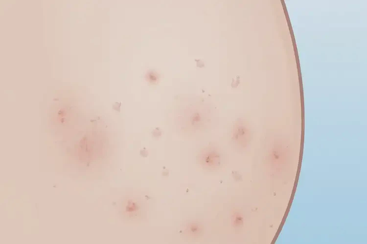 孕婦肚子上偶爾長濕疹不管它會自己痊愈嗎(圖4)