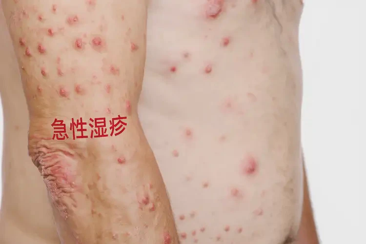 男性四肢偶爾起濕疹可不可以徹底自愈(圖4)