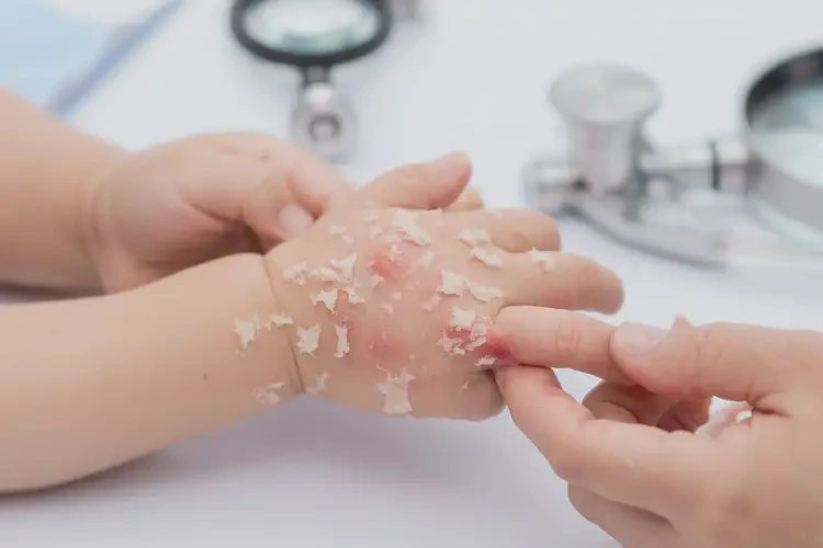 小兒手上經(jīng)常起濕疹不管它會(huì)自己好嗎(圖4)