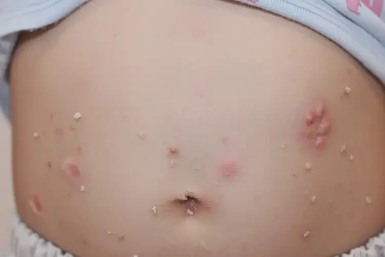 少兒肚子起濕疹不管它會自己好嗎(圖4)