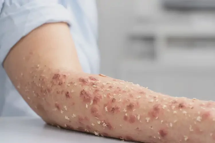 女性手臂經(jīng)常長(zhǎng)濕疹能靠自己自愈嗎(圖4)