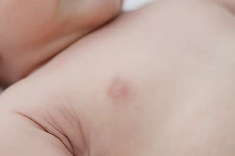 新生兒脖子偶爾長(zhǎng)濕疹可不可以徹底自愈(圖4)