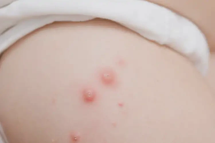 小孩肛周容易起濕疹能徹底自愈嗎(圖4)