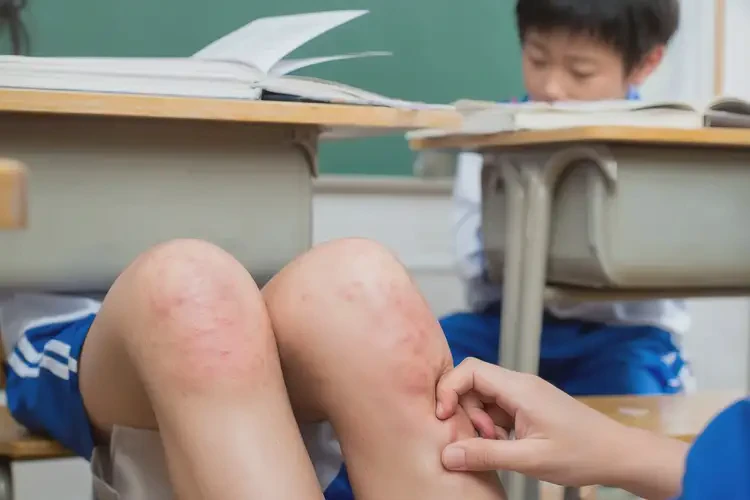 小學(xué)生大腿容易長(zhǎng)濕疹不管它會(huì)自己自愈嗎(圖4)