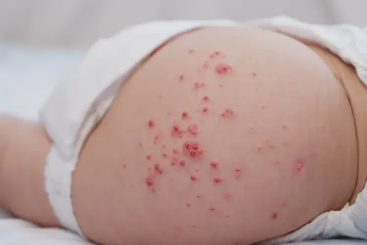 新生兒屁股上容易起濕疹可不可以徹底自愈(圖4)