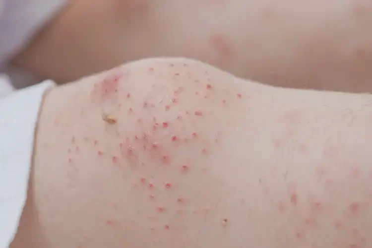 小孩小腿上偶爾長濕疹能徹底自愈嗎(圖4)