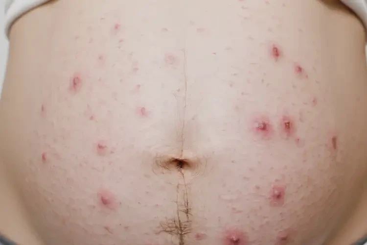孕婦身上長濕疹可以徹底自愈嗎(圖4)