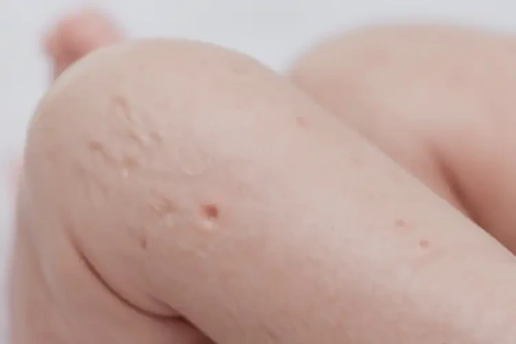 新生兒大腿經(jīng)常長濕疹能夠徹底治愈嗎(圖4)
