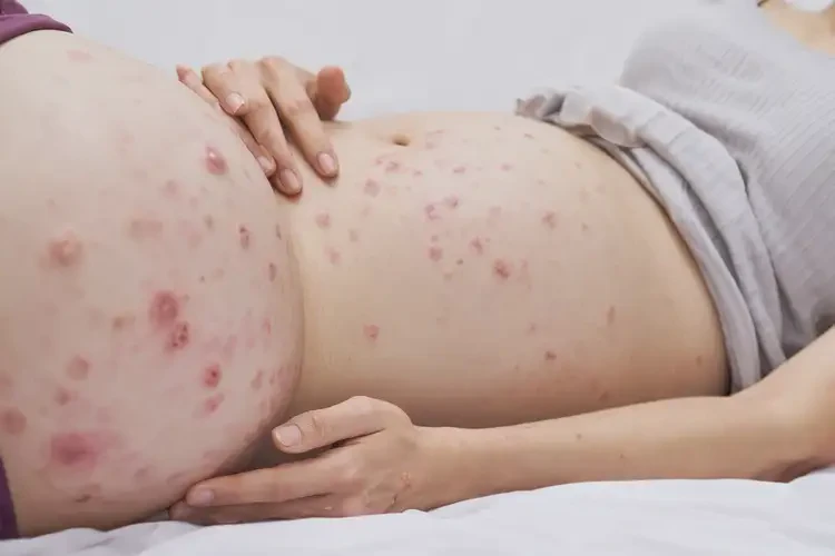 孕婦肚子上起濕疹可以徹底自愈嗎(圖4)
