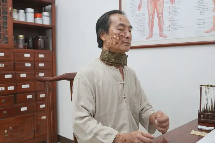 男性脖子上出現(xiàn)濕疹能靠自己自愈嗎(圖1)