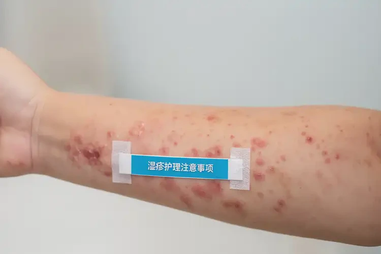 孩子全身出濕疹可以徹底自愈嗎(圖4)