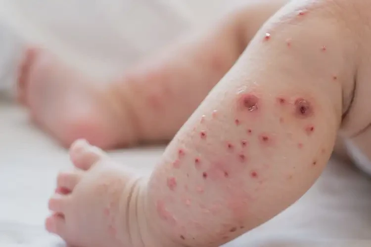 寶寶小腿出濕疹不管它會(huì)自己自愈嗎(圖3)