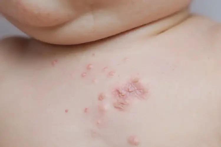 婴儿脖子上容易起湿疹不管它会自己痊愈吗(图4)