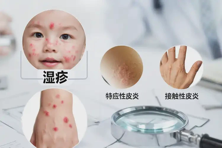 婴幼儿面部出现湿疹不管它会自己痊愈吗(图2)