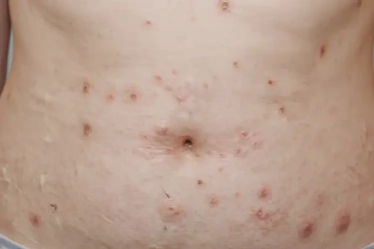 女人肚子容易長濕疹不管它會自己好嗎(圖3)