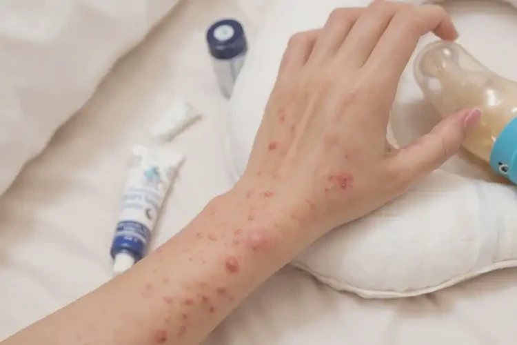 哺乳期妈妈手上出湿疹能不能彻底自愈(图3)