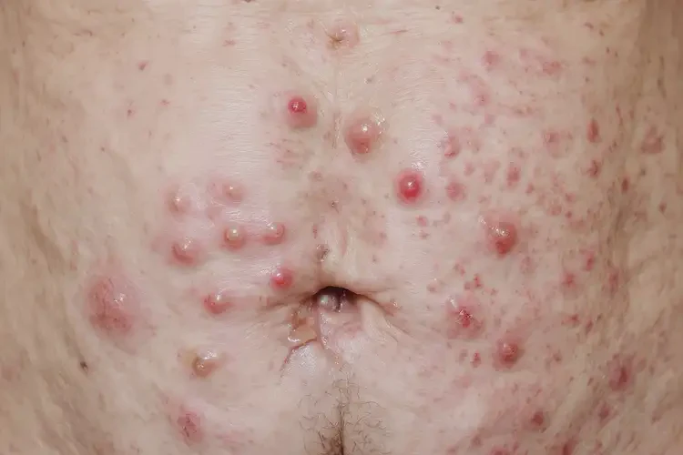 男性肛周出現(xiàn)濕疹可不可以徹底自愈(圖4)