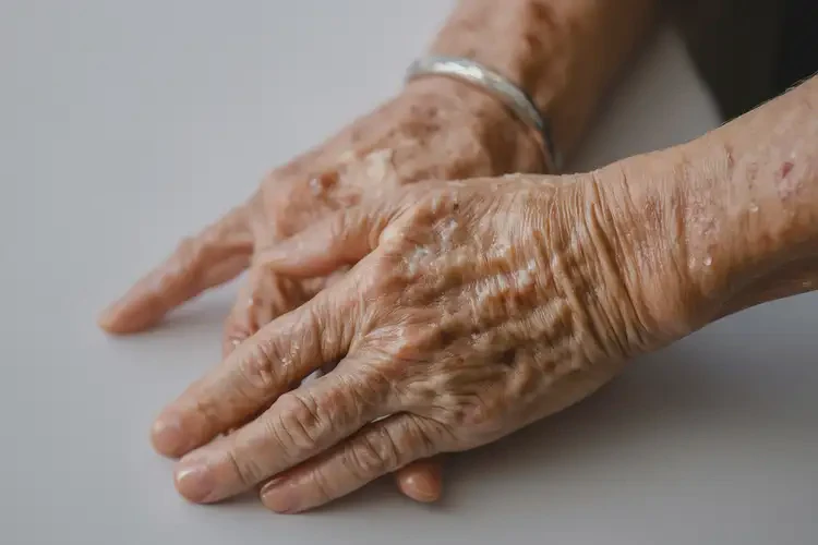 老年人全身容易起湿疹不管它会自己痊愈吗(图3)